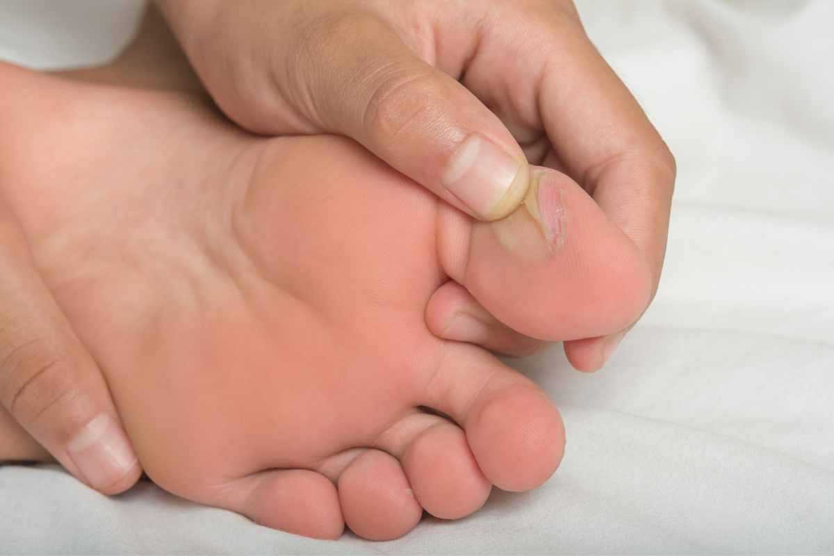 Come curare le vesciche ai piedi